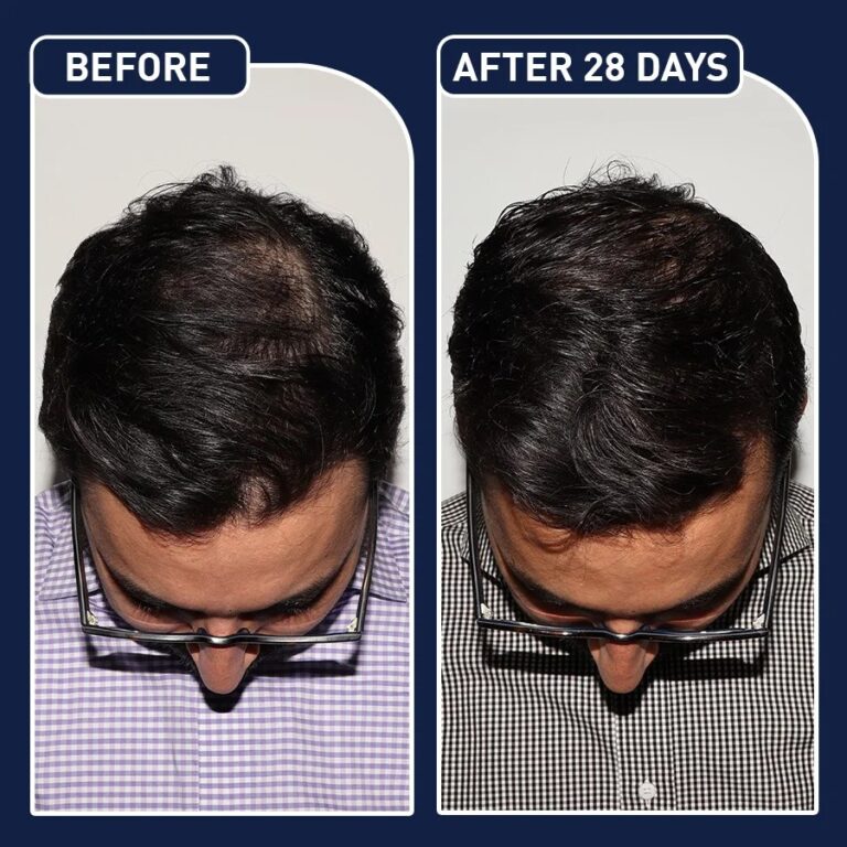 بخاخ دعم نمو الشعر AnaGain Procapil 50 مل